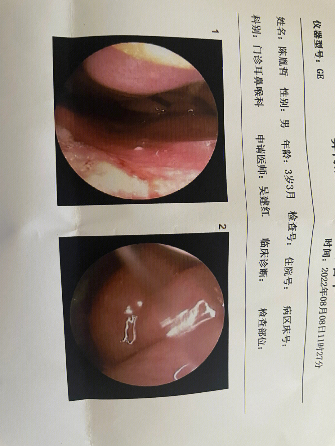 钩突肥大的图片图片