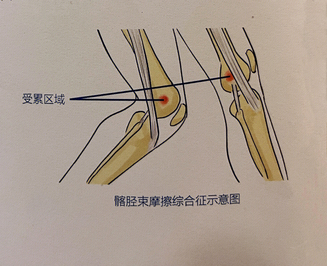 膝胫试验图片