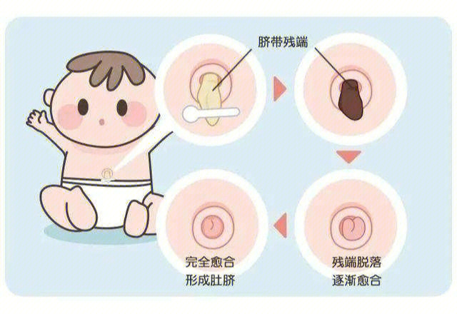 新生儿脐带发炎怎么办图片