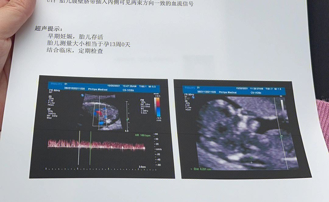 怕市妇幼的nt约不上,11周 3天的时候去了华世佳宝做了一次nt,因为可以