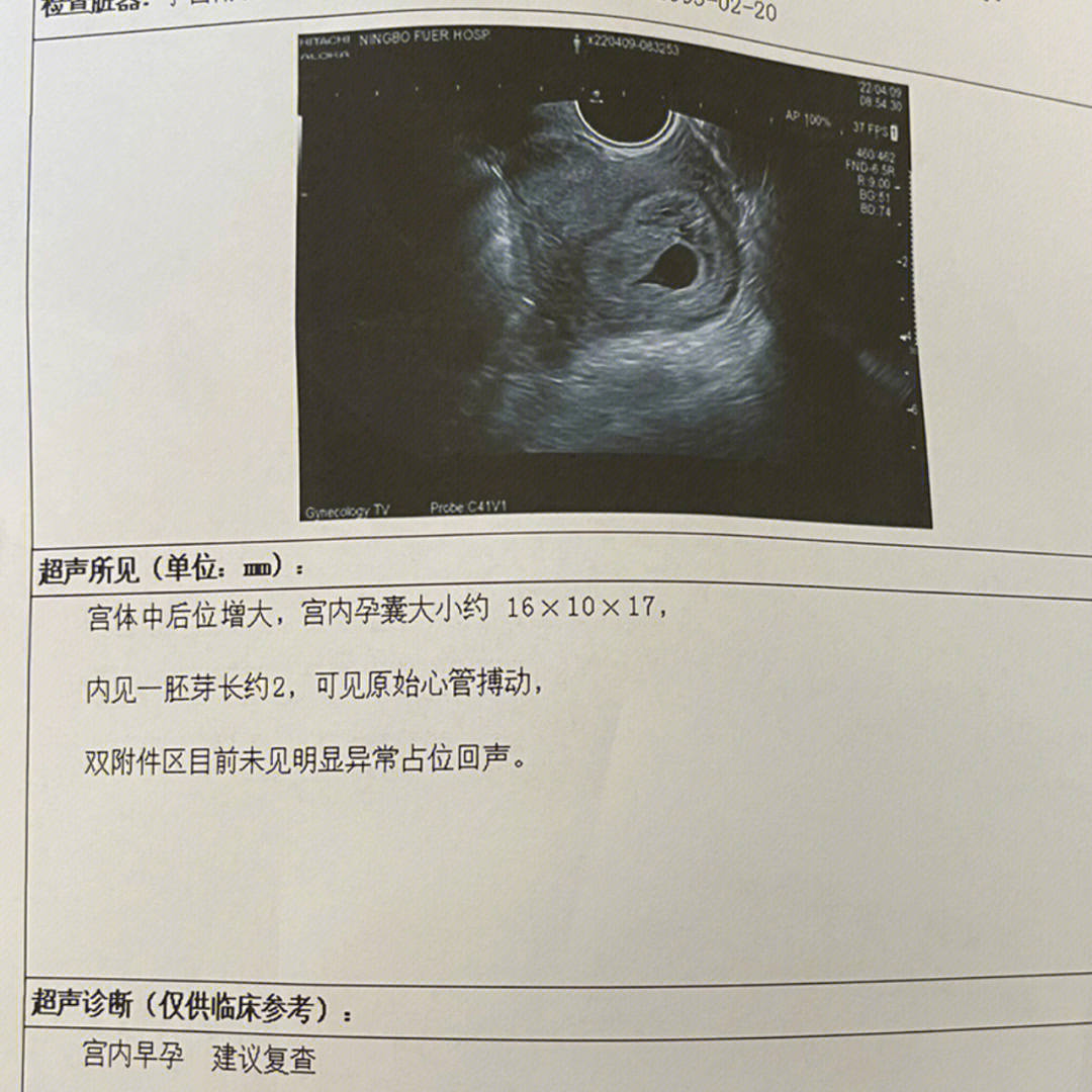 胎芽胎心放大图片图片