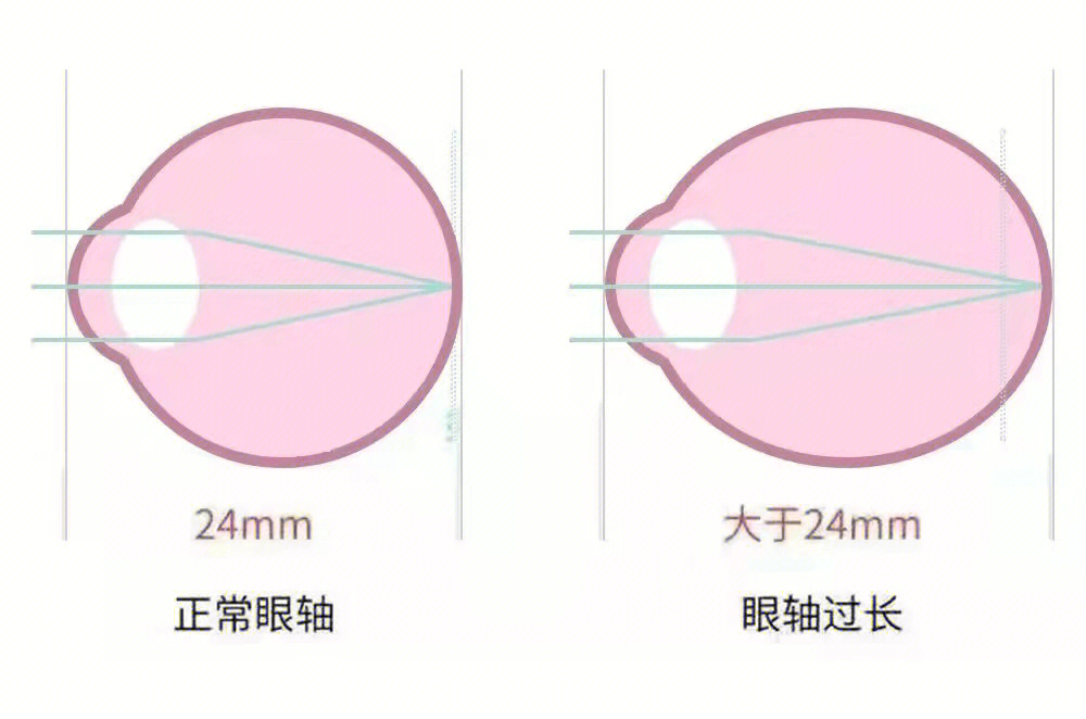 他们都说我摘了眼镜,眼睛无神,而且眼球很凸,不戴眼镜是会不会好一点