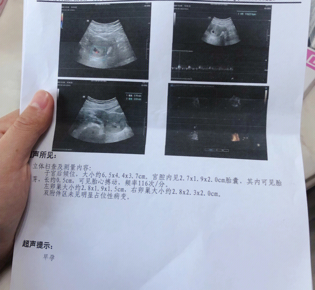 孕6周褐色分泌物先兆流产别担心