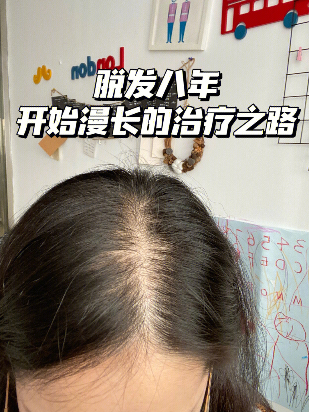 我的脱发治疗之路终于要开始防脱生发治疗