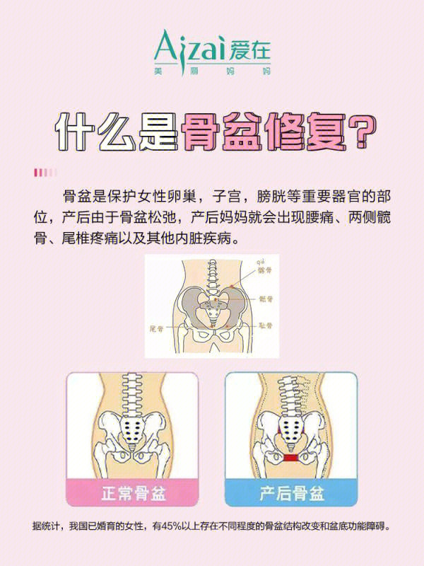 骨盆外扩有什么危害图片