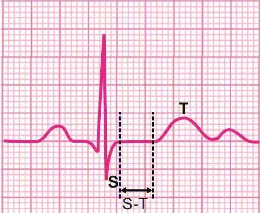 st-t改变实际上是源于心脏电活动的变化,那么也可以说只要有心脏电