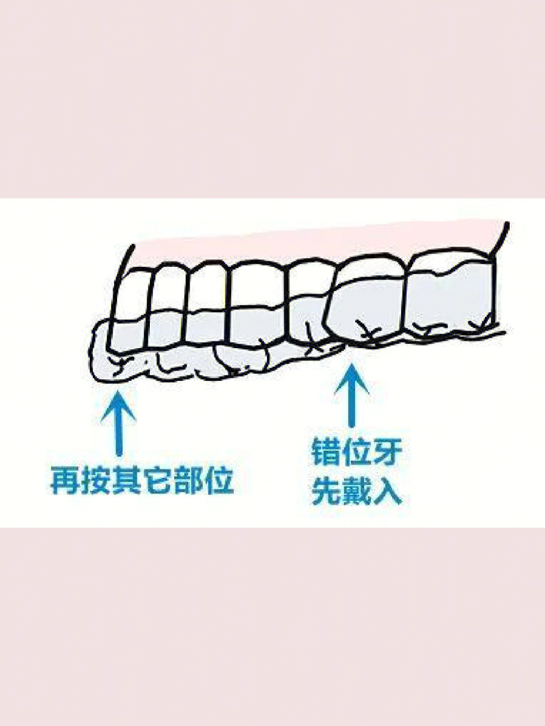 摘牙套的过程图解图片