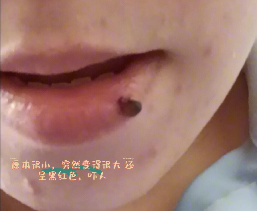 嘴唇血管瘤初期图片
