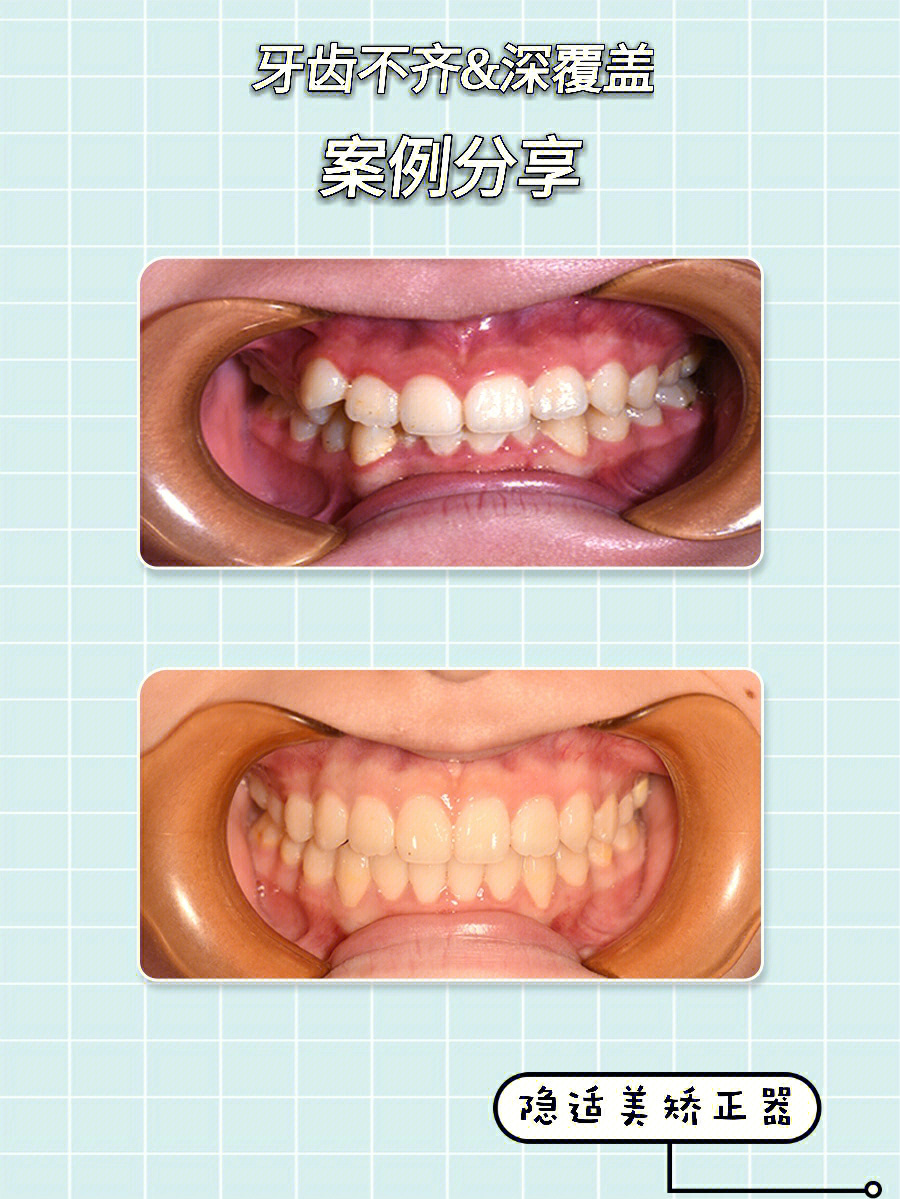牙齿不齐深覆盖悄悄整牙惊艳所有人