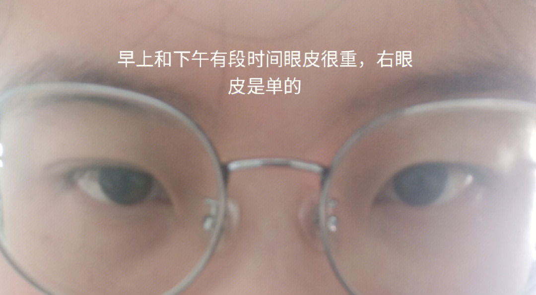 我的右眼皮什么时候才能一直双下去呢