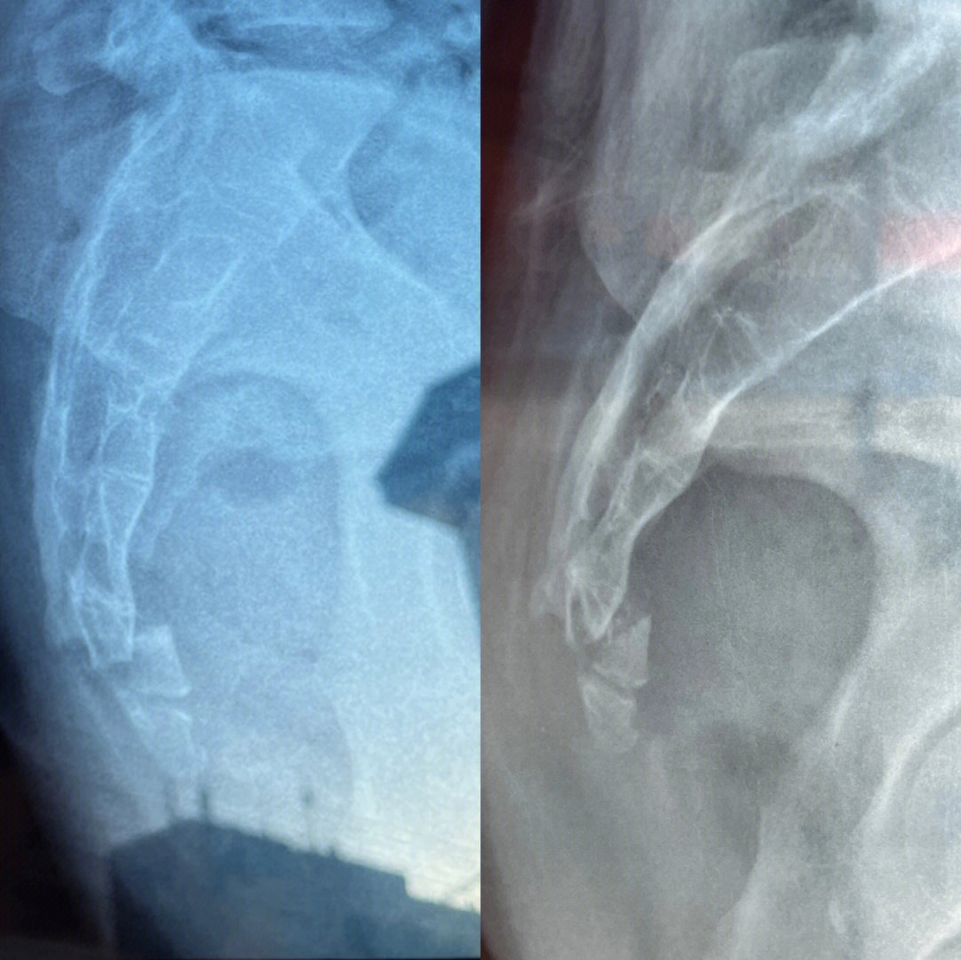 女人骶5椎体骨折图片图片
