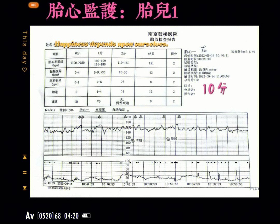 双胎32周胎心监护一次满分通过