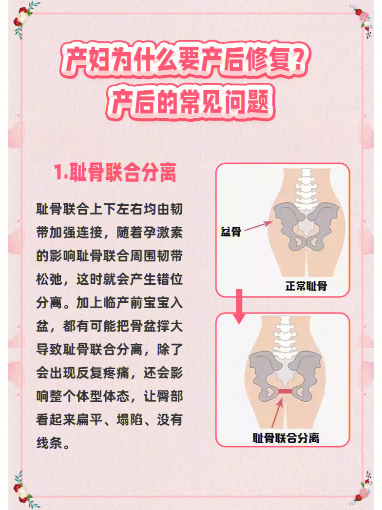 耻骨联合分离怎么办图片