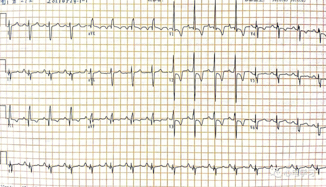 肺栓塞心电图诊断图片