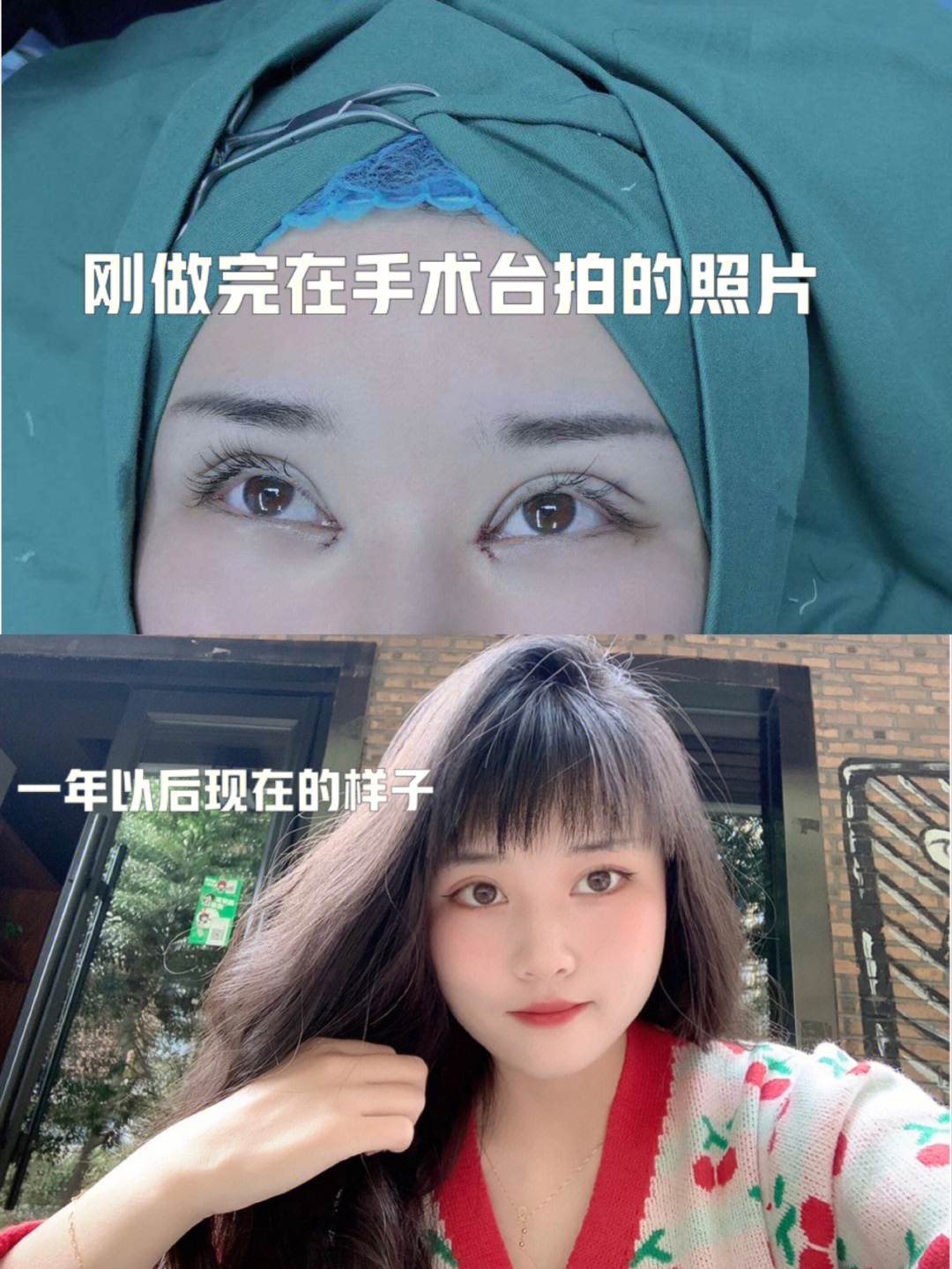 割双眼皮的恢复过程图图片