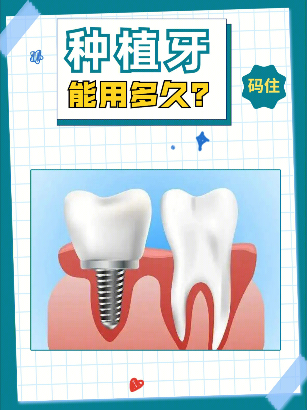 种植牙能用多久71
