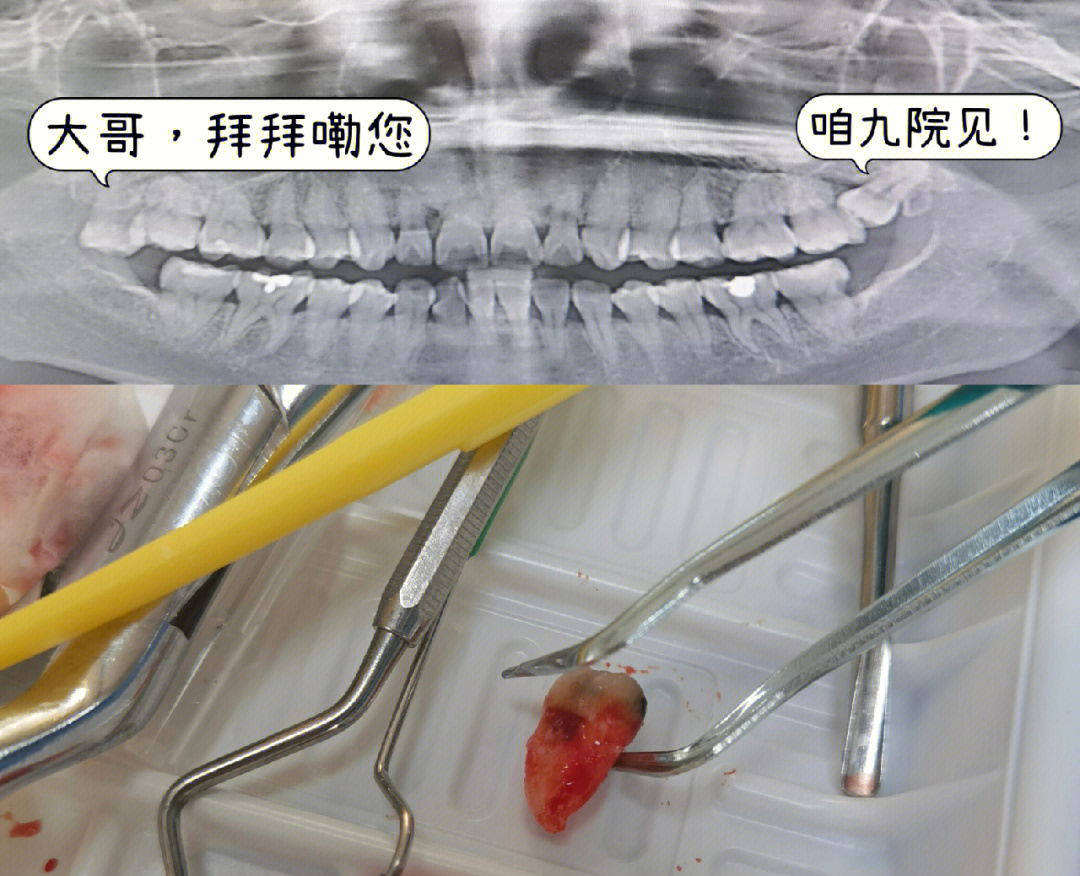 阻生牙一定要拔吗图片