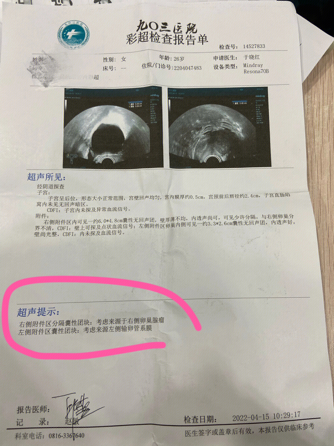 子宫囊腺瘤图片