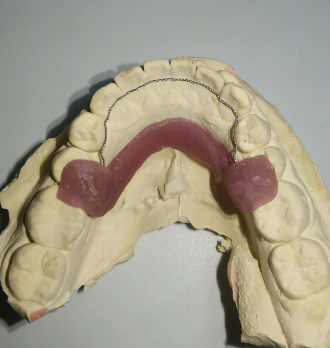 由于牙齿在新的位置仍然不稳定,往往需要佩戴保持器,将牙齿保持在牙槽