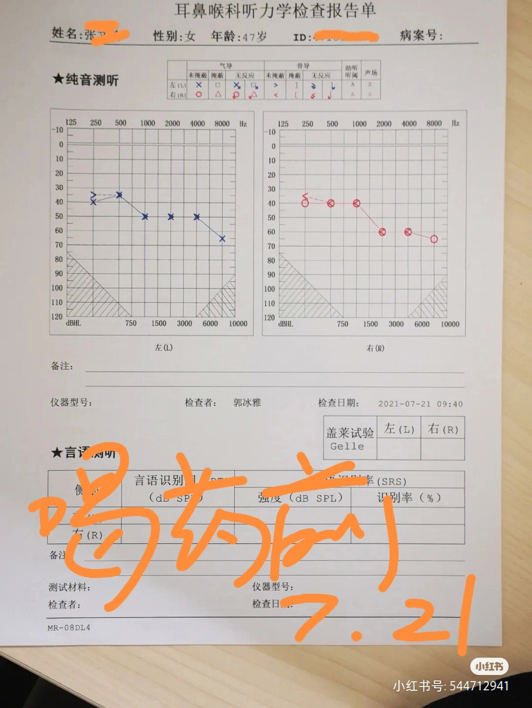 神经性耳聋喝三个月中药后听力下降了