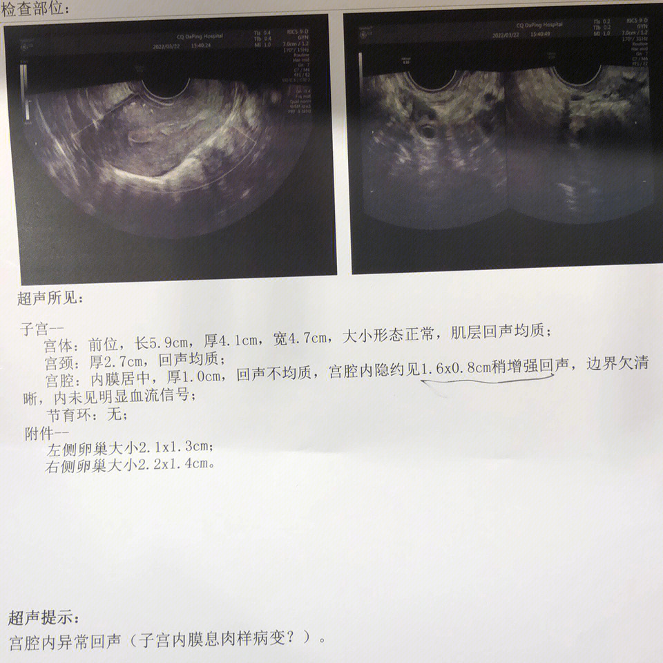 宫颈息肉病理报告图片