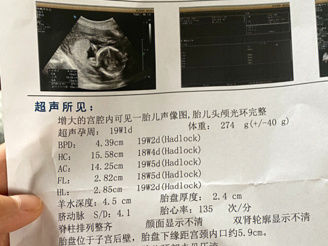 怀孕19周胎儿彩超图图片