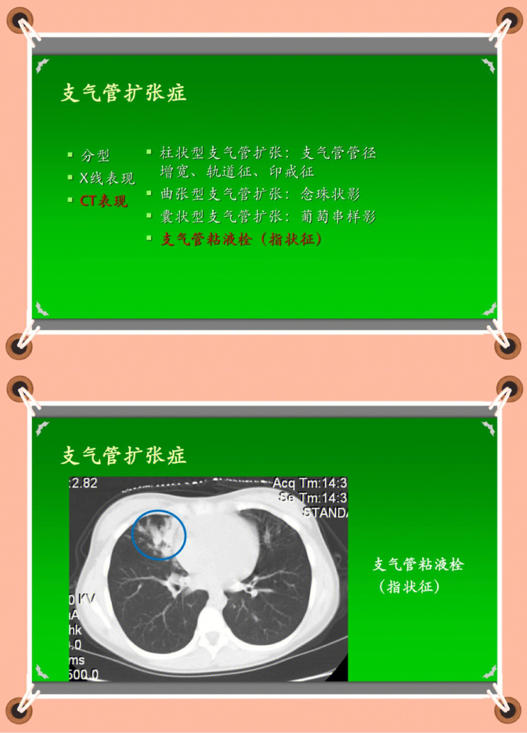 呼吸系统疾病诊断支气管扩张3