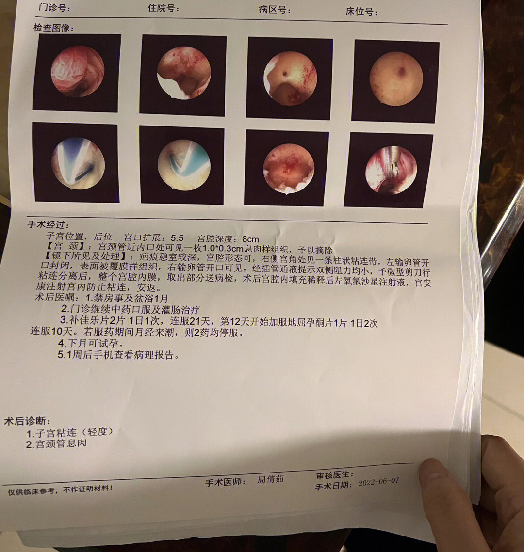 因为副作用小 ,没想到的是宫内问题不少,从未做过清宫术也会导致粘连