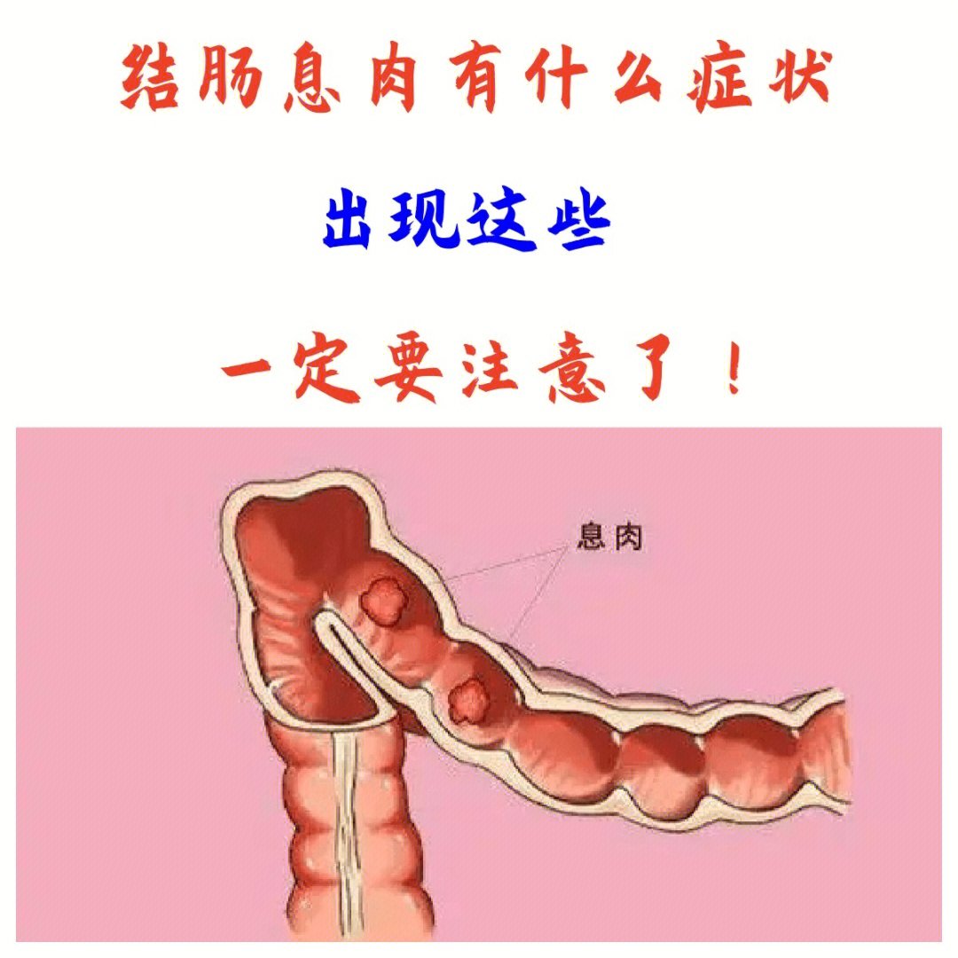 结直肠息肉有哪些症状?