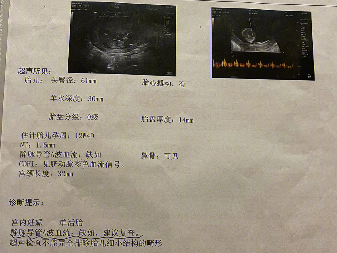产检|nt检查-静脉导管a波缺如,我选羊穿