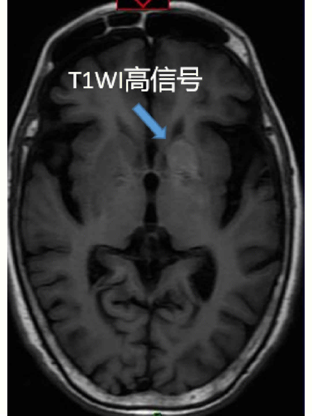 基底节区mri图片