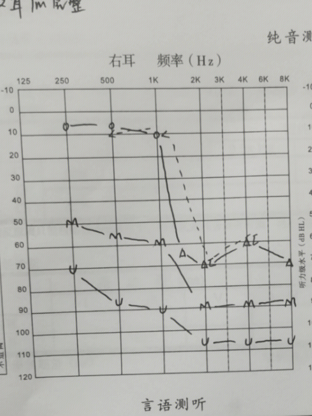 耳硬化症纯音测听图图片