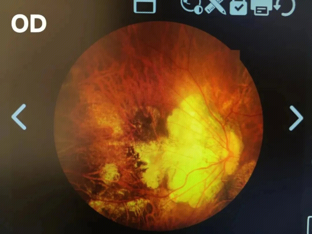 弥漫性及局灶性脉络膜视网膜萎缩,后巩膜葡萄肿,黄斑裂