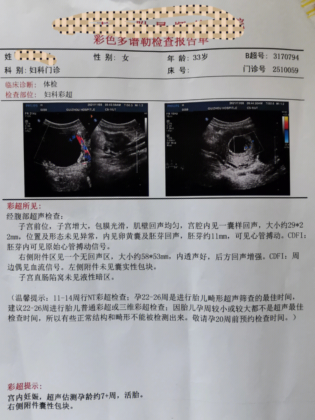 纳氏囊肿影响怀孕吗图片