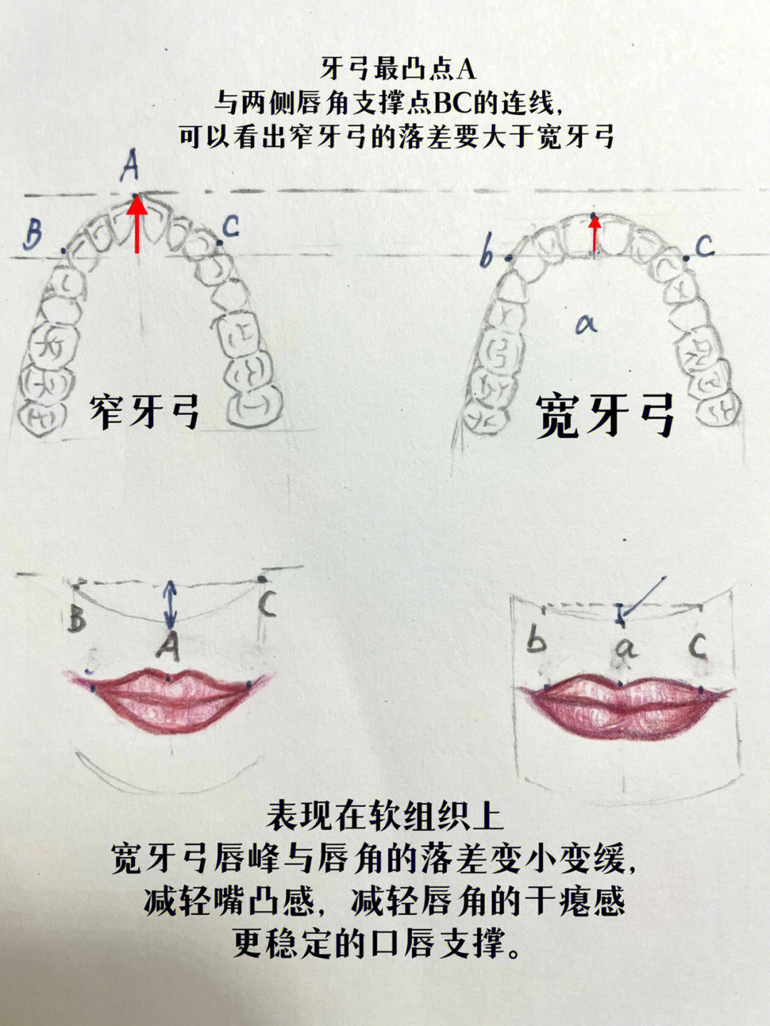 牙套日记6  扩弓 大龄正畸的好帮手?