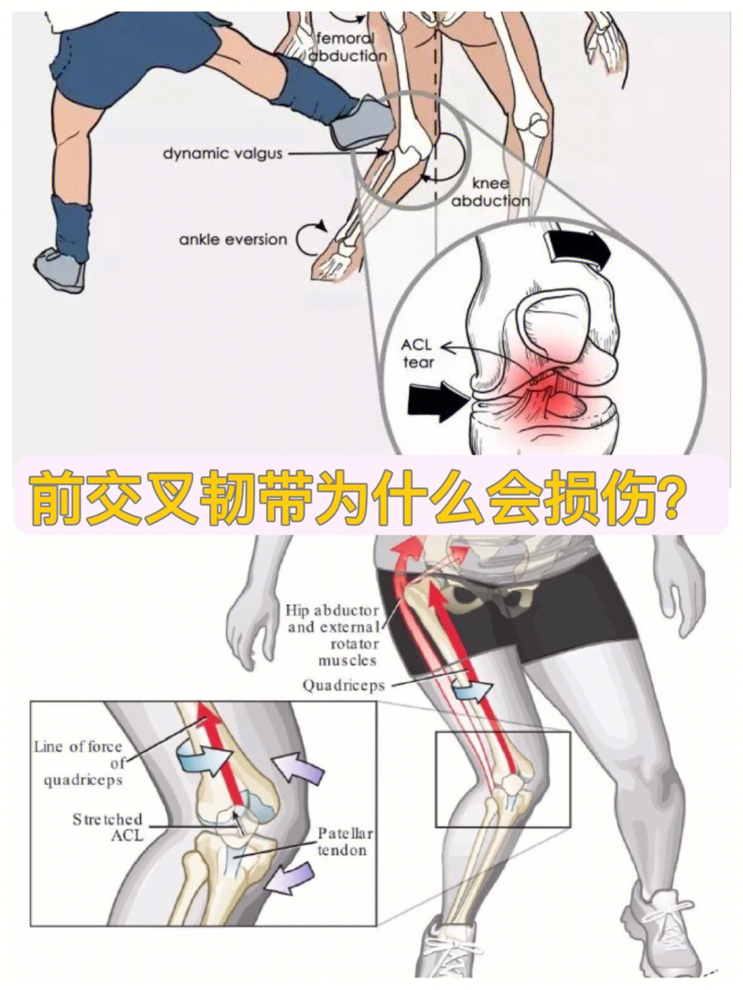 前交叉韧带为什么会断裂损伤机制