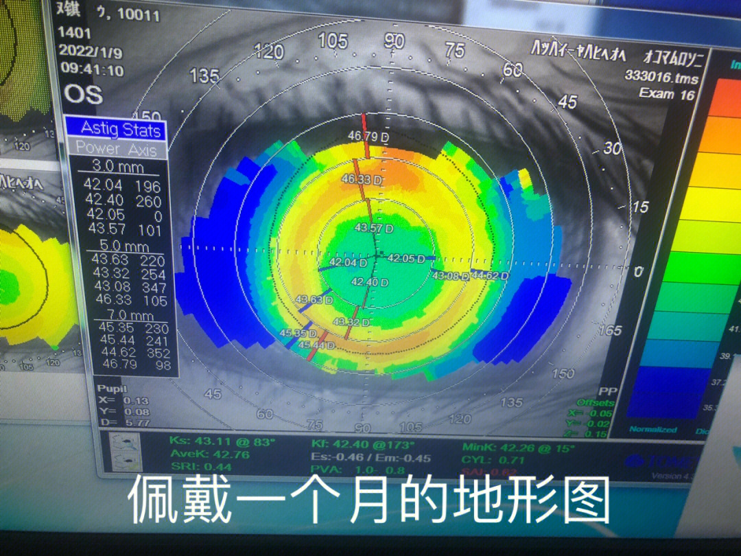 角膜塑形镜一个月地形图红色较少,视力不太稳定