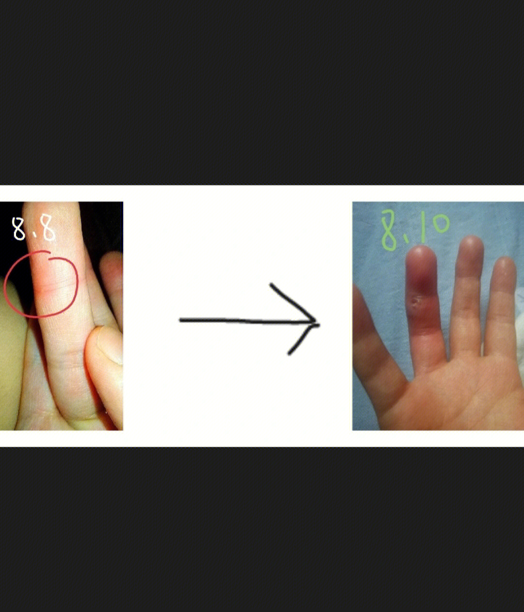 手指扎刺ganran化脓过程