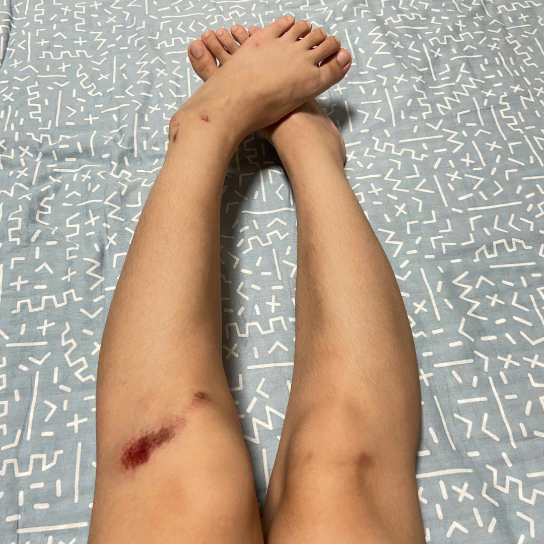 女孩腿被撞肿了的图片图片