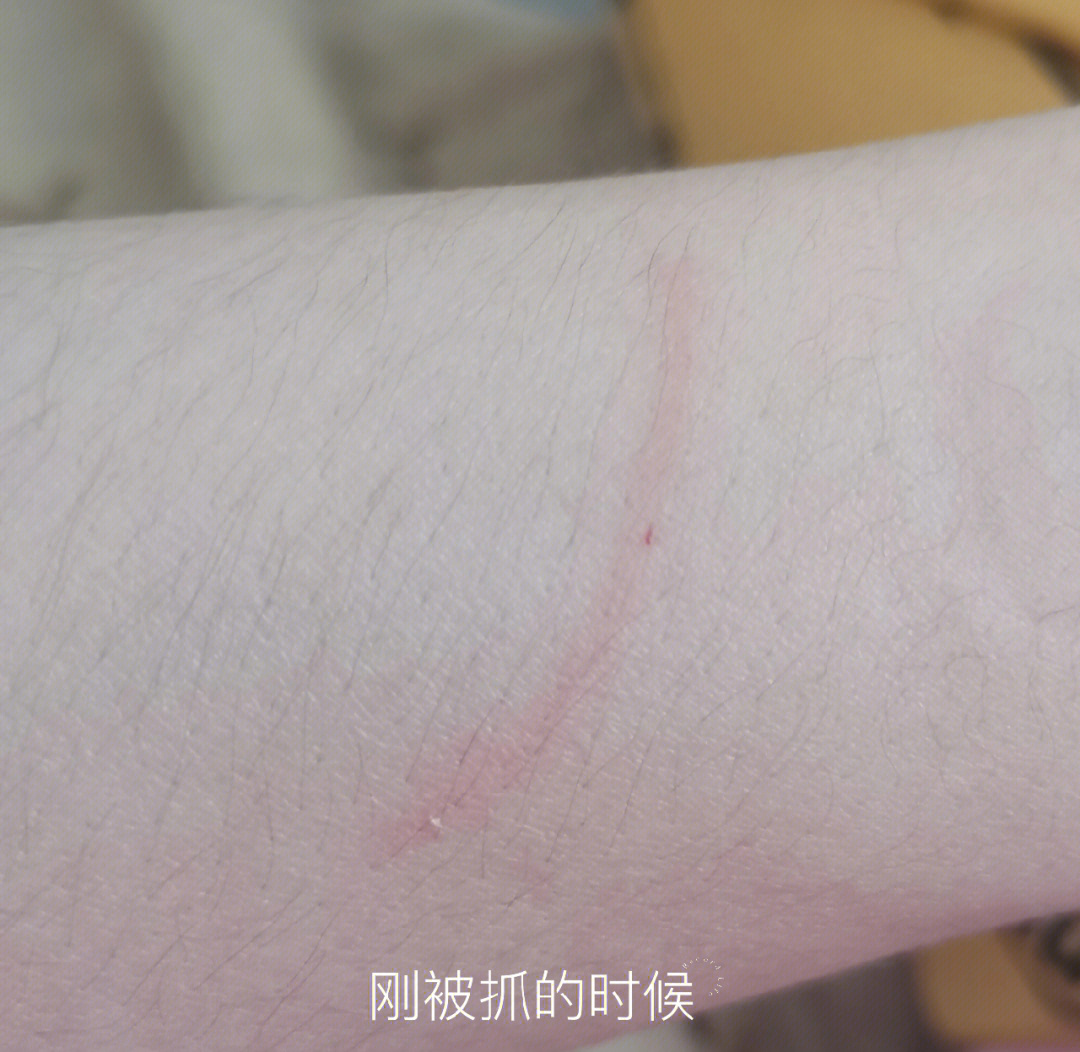 被小猫抓了需要打狂犬疫苗吗