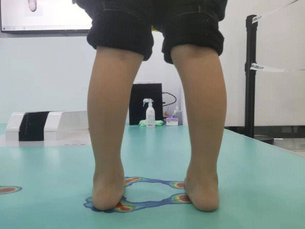 足弓发育迟缓,并且因为足外翻的原因,已经形成了明显的小腿外翻,预计