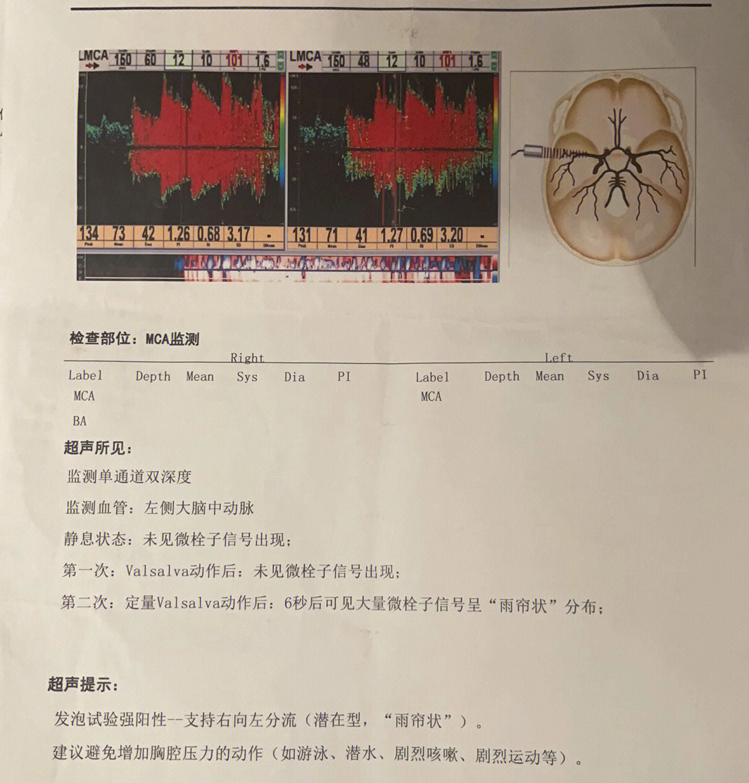 卵圆孔未闭和房缺图片