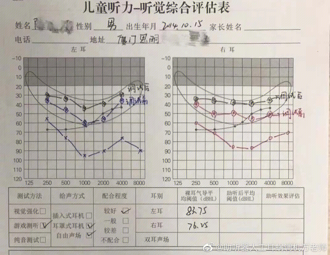 耳硬化症纯音测听图图片