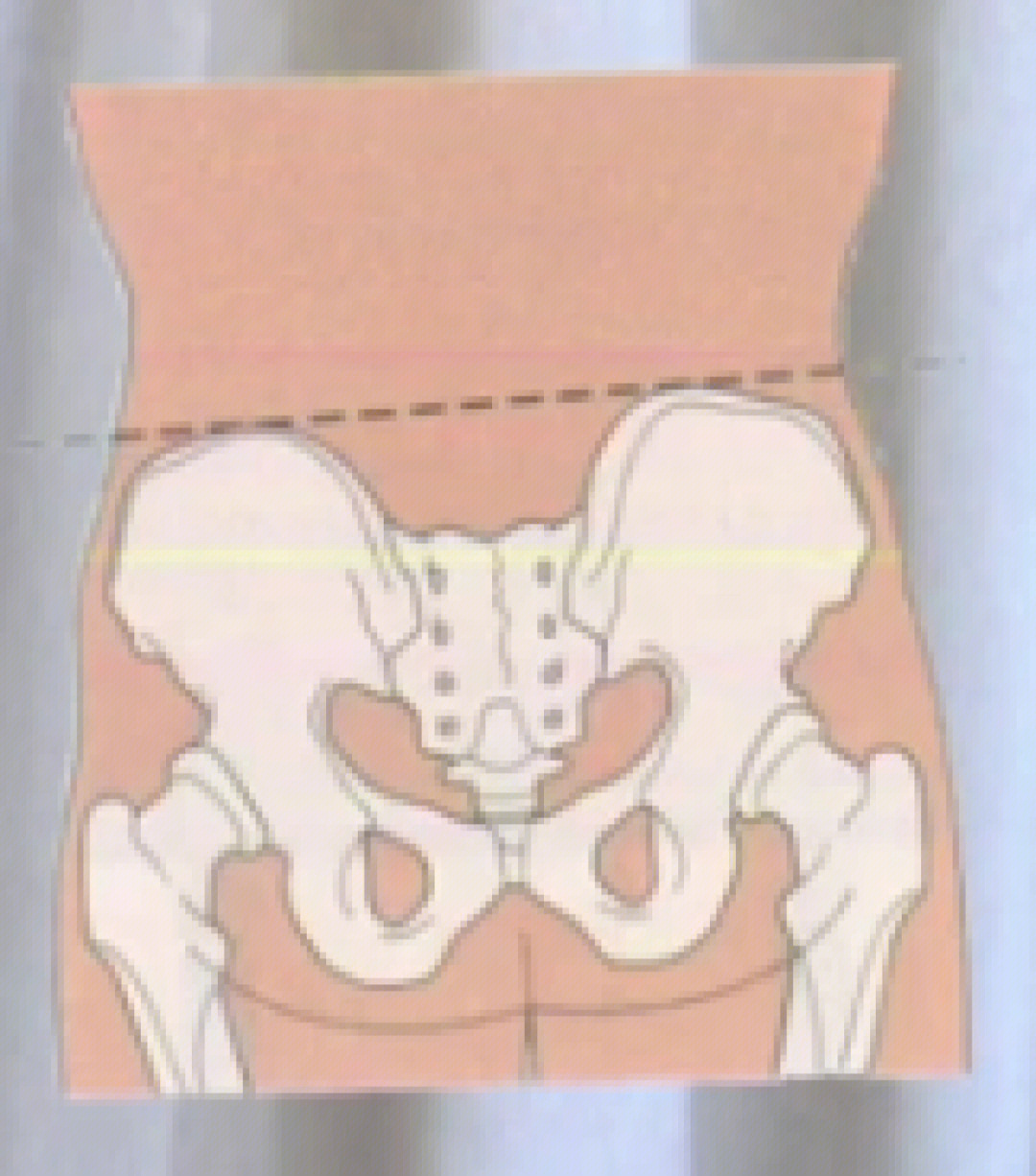 骨盆左高右低矫正图解图片