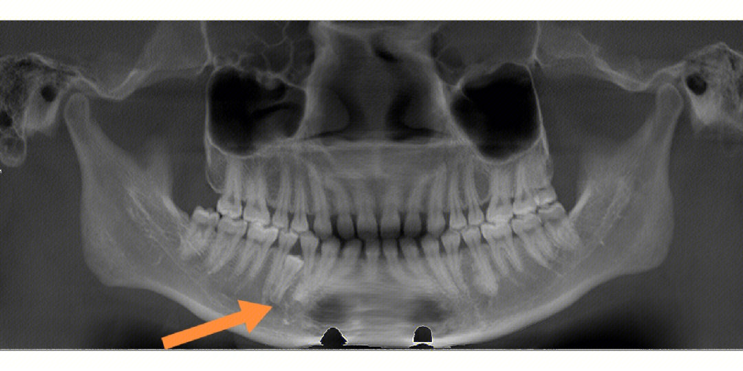 正畸需要,拔除右下后牙区埋伏多生牙