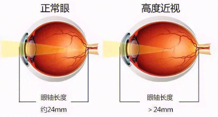 近视眼与正常眼睛外观图片