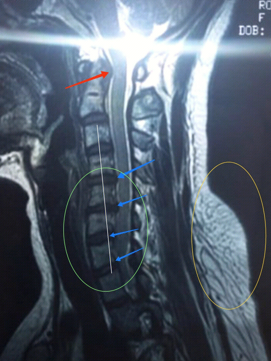 寰椎位置改变影响延髓走行延髓都重要性