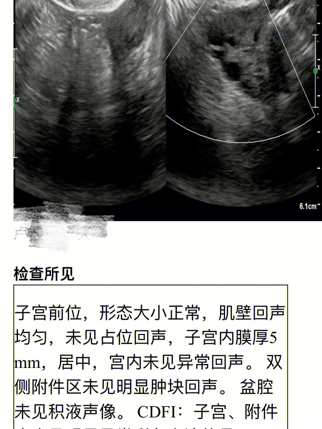 白带常规检查子宫异常出血