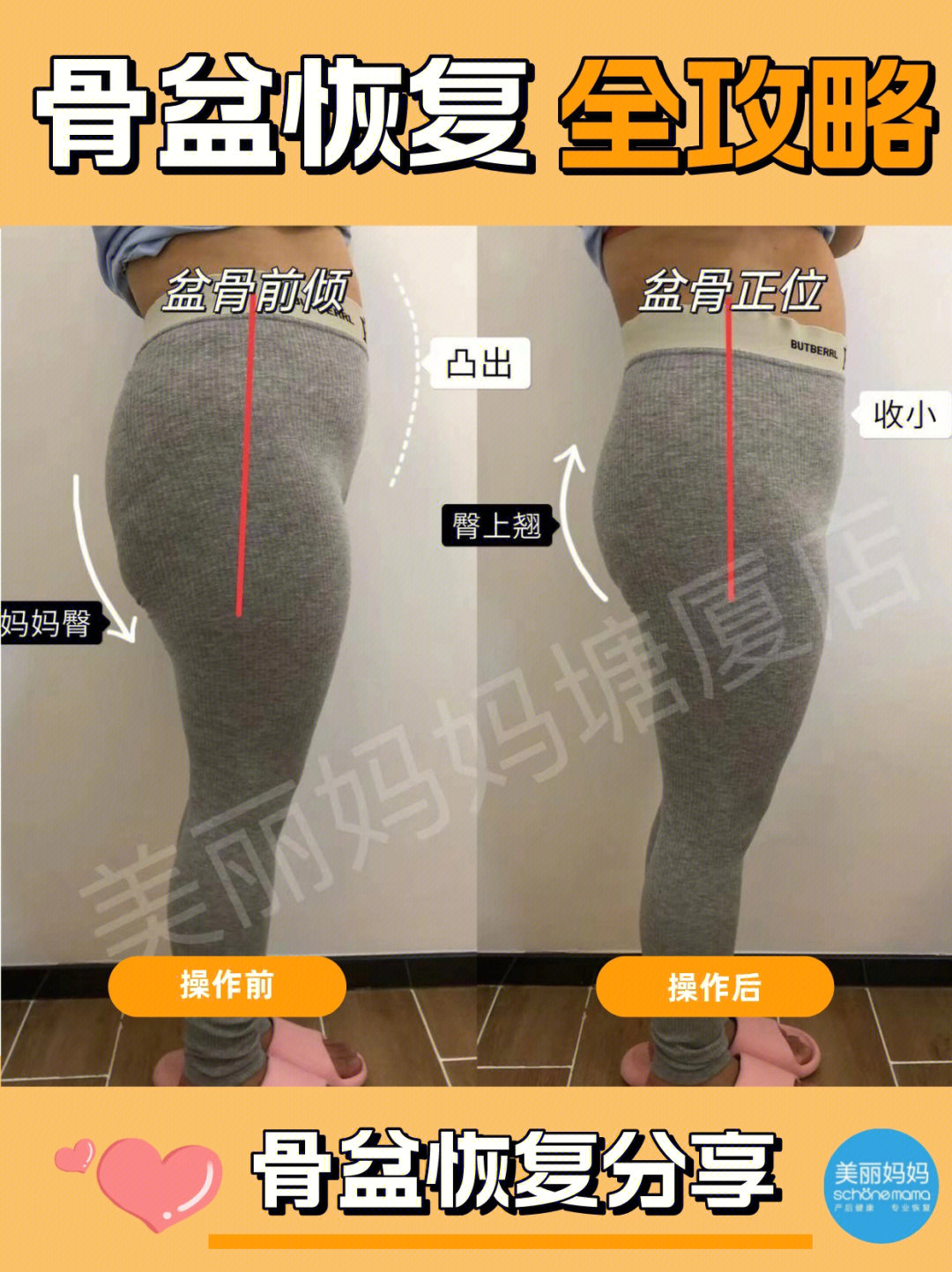 骨盆修复