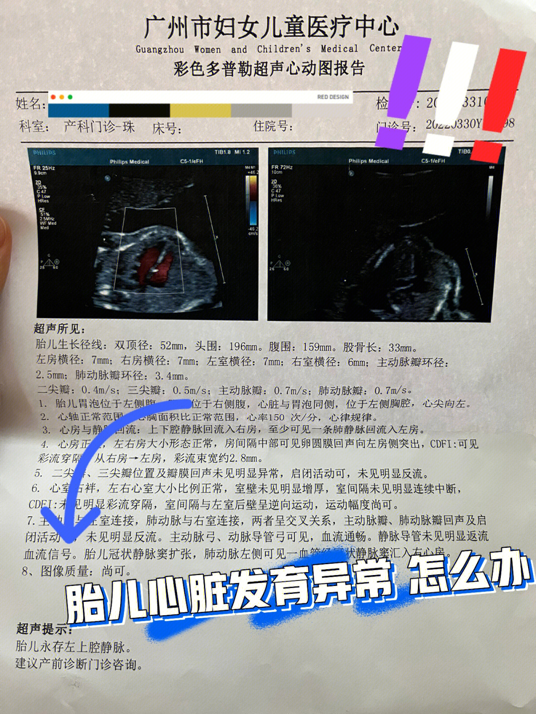 孕21周时拿着筛查卷去天河妇幼做了免费的大排畸,发现了崽崽的心脏